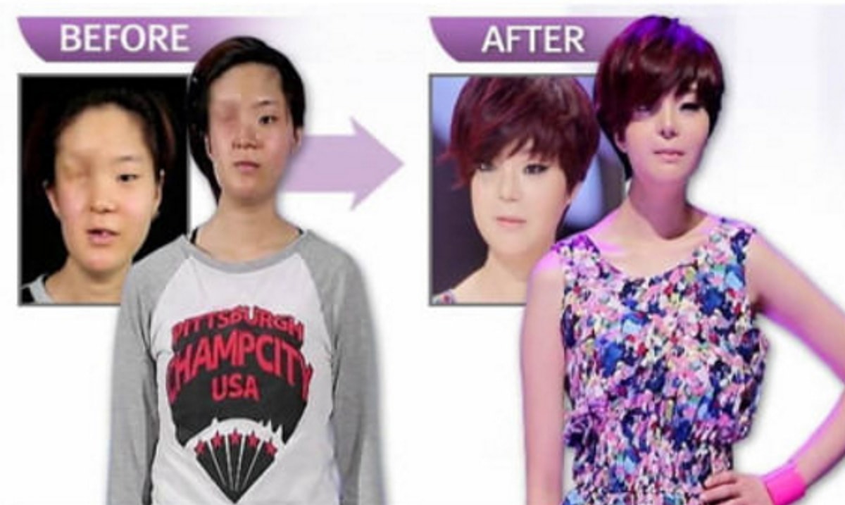 19 Mind Blowing Before And After Faces From South Korea S Plastic