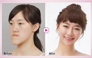 Mind Blowing Before And After Faces From South Korea S Plastic