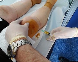 Diz Kireçlenmesinde Yeni Umut: Prp Tedavisi