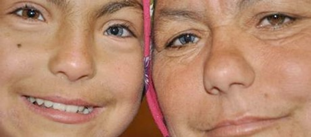 Bir insanda iki göz rengi? (sağ başka, sol başka renk)