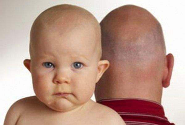 9. Saç dökülmesi genetik olarak sadece anne ve baba tarafından belirlenir.