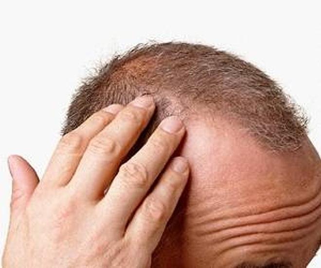 Saç Dökülmesi – Soru ve Cevapları