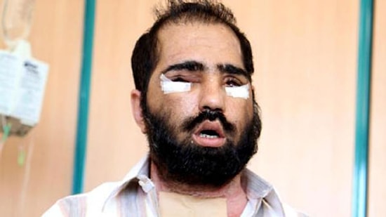 Altıncı Yüz Nakli Yapılan Salih Üslün'ün Yüzü Çıkartılıyor