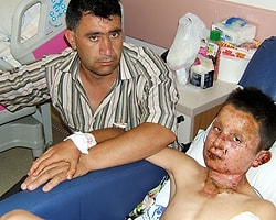 İftar Topu Yerine Atılan Ses Bombası Çocuğun Elinde Patladı