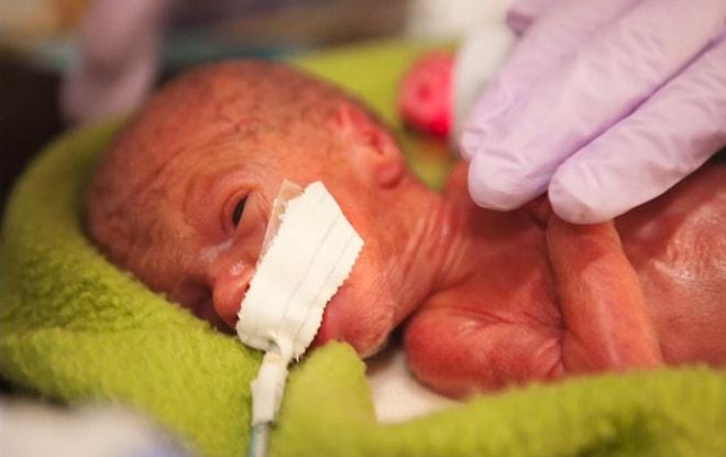 Premature Doğan Bebeğin 80 Günlük Yaşama Tutunma Mücadelesinin İnanılmaz Görüntüleri
