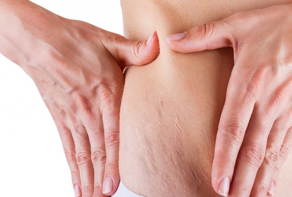 Çatlaklar İçin Doğal Formül