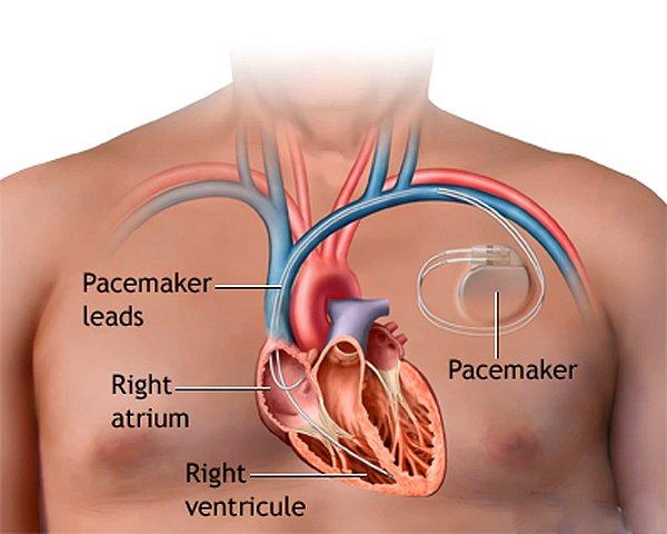 Kalbin bu ayarı yapamadığı durumlarda, kalp atış hızını ayarlayan elektronik cihazlardan faydalanılır.