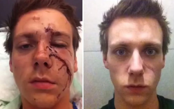 Bir Gencin Kafasında Patlayan Şişeden Sonra Gün Gün Geçirdiği İyileşme Süreci