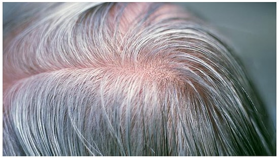 Stres, Saçı Bir Gecede Beyazlatır mı?