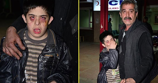 Down Sendromlu Şakir Bu Hale Nasıl Geldi?