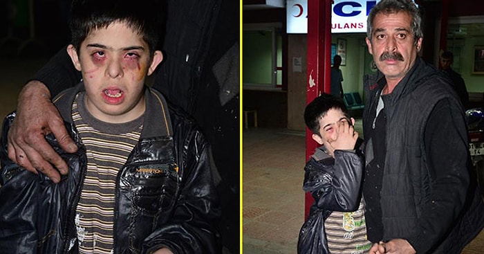 Down Sendromlu Şakir Bu Hale Nasıl Geldi?