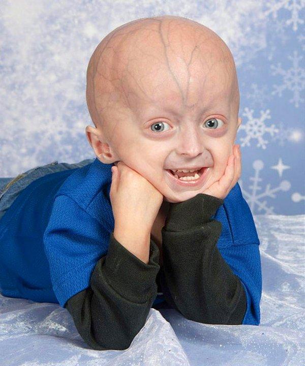 5. Telomeraz enzimi kromozomların kısalmasını engeller fakat vücutta bu enzimin eksikliğinden dolayı Progeria ortaya çıkıyor olabilir.