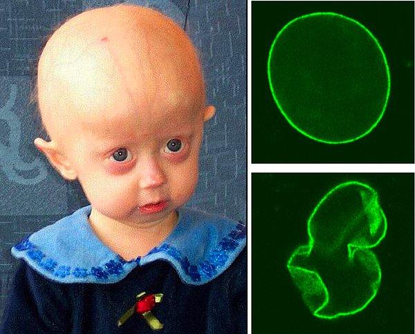 8. Sağ üst tarafta normal ve sağlıklı bir hücre çekirdeğini görüyorsunuz. Onun altındaki ise bu hastalığın ortaya çıkmasına neden olan progeric hücre çekirdeği.