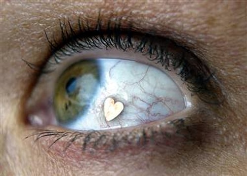 Göz küresi implantı