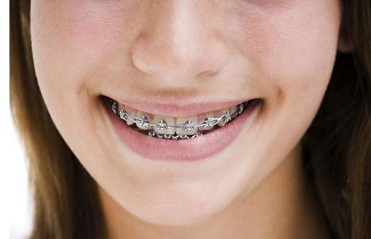 Брекеты на зубы для детей сколько стоят. Керамические брекеты на клыки.