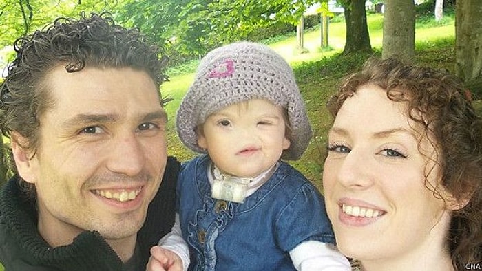 3D Yazıcı ile 2 Yaşındaki Kıza Burun Yapılacak