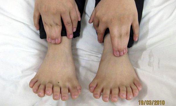 8. Çin'de bir çocuk 31 parmak ile doğmuş ve sonrasında bu ekstra parmaklar bir operasyonla alınmış.