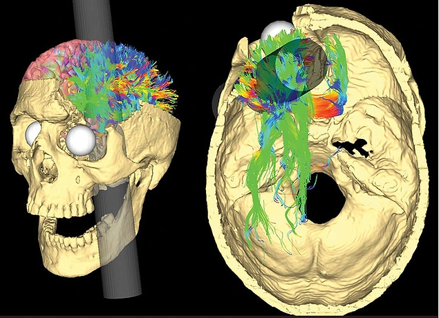 Gage'in kişiliğindeki değişimin sebebi beynin "prefrontal korteks" denilen kısmındaki hasardı.