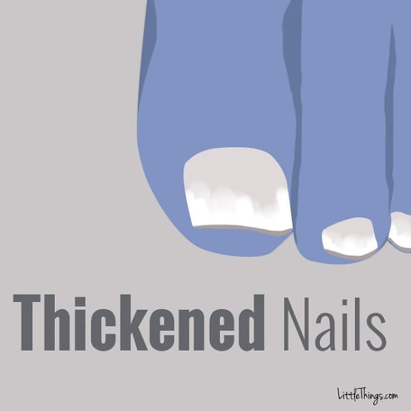 3. Утолщенные ногти на ногах