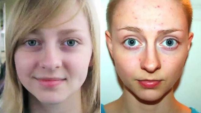 Saçlarını Tutam Tutam Yolmasına Sebep Olan Hastalık Yüzünden Kafasını Kazıtan Genç Kız