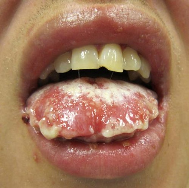 11. Stevens-Johnson Sendromu (Toksik Epidermal Nekroliz)