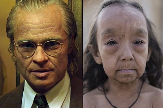 Sıra Dışı Hastalıkları Yüzünden Doğumlarından Beri Yaşlı Görünen 'Benjamin Button' Kardeşler