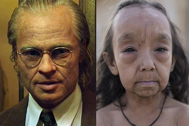 Sıra Dışı Hastalıkları Yüzünden Doğumlarından Beri Yaşlı Görünen 'Benjamin Button' Kardeşler