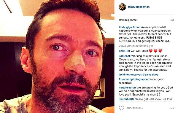 Geçtiğimiz günlerde de Instagram hesabından, bandajlı burnuyla bir fotoğrafını paylaşan Jackman, hayranlarını uyardı.