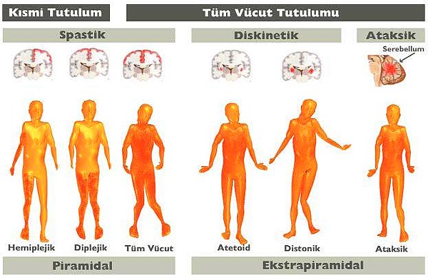 Hastalığın farklı tipleri bulunmaktadır.