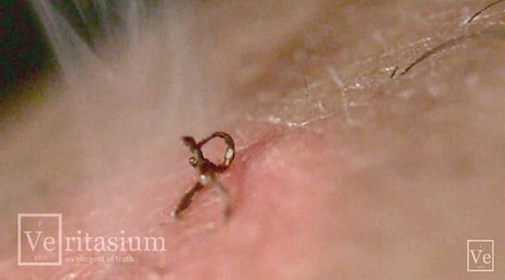 Lazer Yaptırmadan Önce Bir Kez Daha Düşünün! Ağır Çekim Görüntüleriyle Lazer Epilasyon