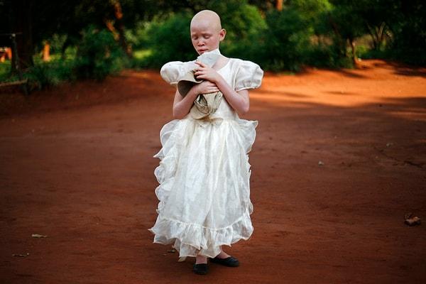 9. Görme engelli albino bir kız çocuğu, Malingunde Köyü'nde bulunan ve özel ihtiyaçları olan çocuklara hizmet veren bir tesiste. Malavi, Afrika.