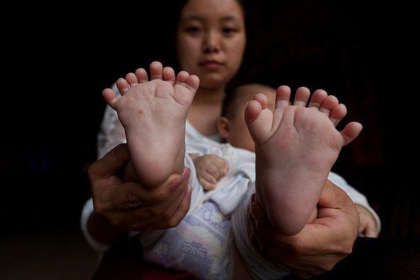 Hong Hong bundan yaklaşık 4 ay önce, 15 el ve 16 ayak parmağı ile doğdu. Her iki elinde de ikişer avuç içi var. Her bir ayağında ise sekiz parmak var.