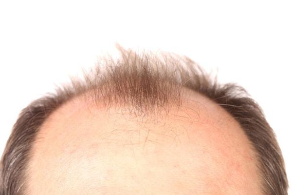10. Her yıl ortalama 800.000 insan saç dökülmelerine karşı sunulan tedavi yöntemlerine başvurmaktadır.