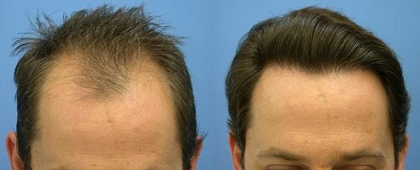 12. Son yıllarda geliştirilen teknikler sayesinde bugün insanların %60'ı saç ektirmiş kişileri tespit edemiyor.