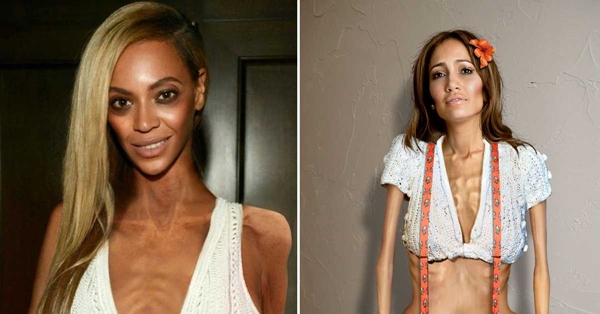 Yalangoch anoreksik fotosuratlar