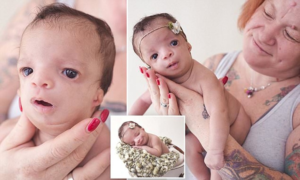 Nadir Görülen Bir Sendromla Dünyaya Gelen Minik Abigail'in Yürek Burkan Hikayesi