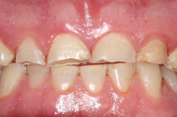 Oldukça sık rastlanan diş gıcırdatma (bruksizm), çoğunlukla uyku esnasında oluşan güçlü çene hareketlerinin neden olduğu çeneleri sıkma, dişleri gıcırdatma olayıdır.