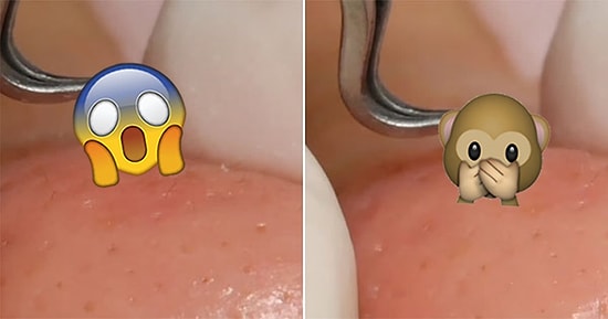 Siyah Nokta Temizleme Becerisini Etkileyici Bir Videoyla Sergileyen Güzellik Uzmanı