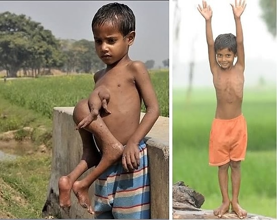 Göğsünde İkizinin Bacak ve Kollarıyla Dünyaya Gelen Çocuk