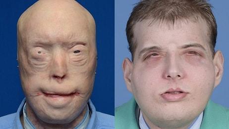 Yüzünün Yanmasının Ardından Dünyanın En Kapsamlı Yüz Nakli Yapılan Adam: Patrick Hardison