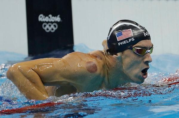 Son olarak madalya bükücü Michel Phelps'in sırtında rastlanan izler tekrardan gündem oldu.