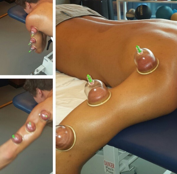 5. Пловцу Натану Эдриану ставят банки перед выступлением