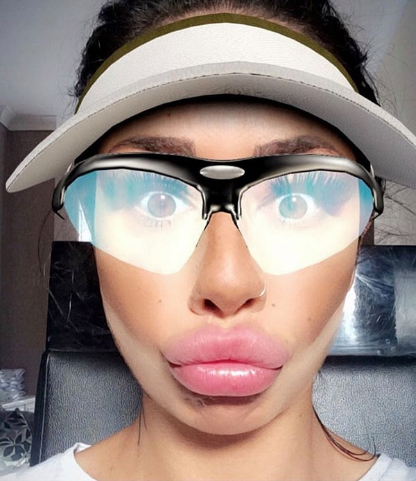 2. 30-летняя Alia Byrne из Ливерпуля всегда мечтала о губах "уточкой", поэтому на определенном этапе своей жизни отправилась в клинику осуществлять задуманное.