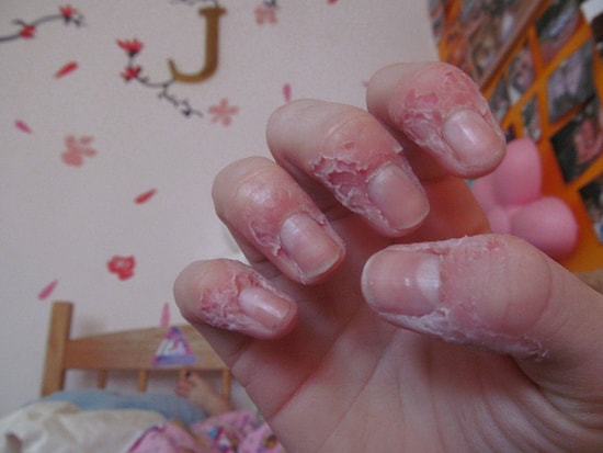 Kendi Derisini, Hatta Etini Yiyenlerin Muzdarip Olduğu Ürkütücü Hastalık: Dermatofaji