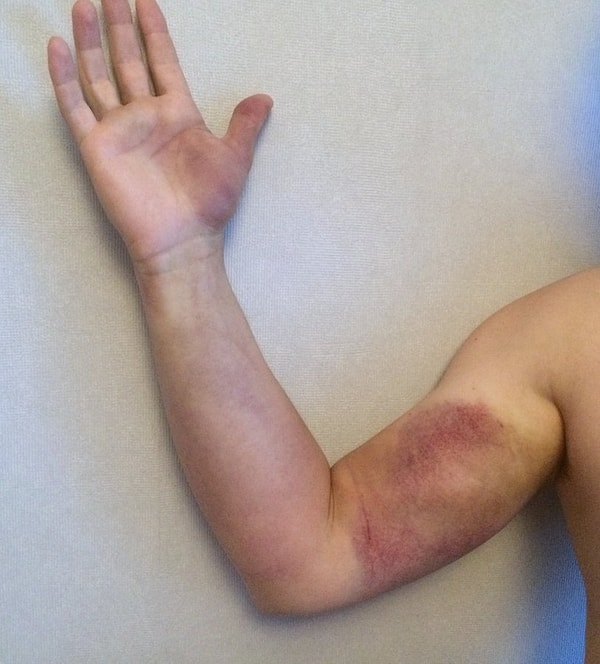 "Из больницы выпустили на третьи сутки. Рядом лежал мужик с укусом в ногу. Он пролежал тут уже неделю и его оставили лечиться дальше. Яд гадюки оказал на его организм такое мощное влияние, что кожа на ноге лопнула от опухоли"