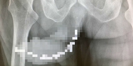 Çok Kızdığı Sevgilisi Sarhoşluktan Sızınca Penisine 9 Tane Vida Saplayan Atarlı Kadın