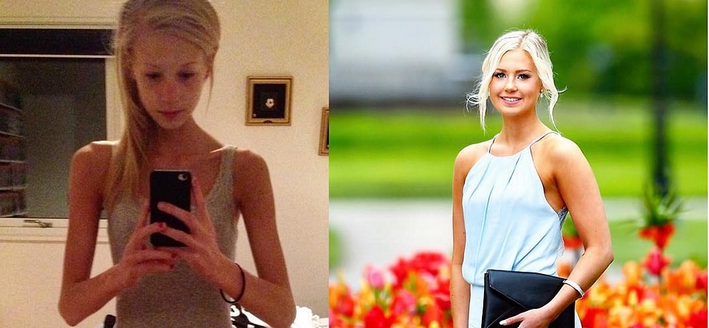 Стремящаяся похудеть девушка весила 30 килограммов и чуть не умерла