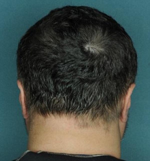 4 ay boyunca süren deneylerde, katılımcıların saçlarını ortalama %92 oranında geri kazandığı belirtiliyor.