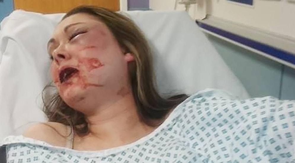 Seks Teklifini Reddettiği Erkek Arkadaşı Tarafından Şiddet Gören Kadının Cesur Paylaşımı