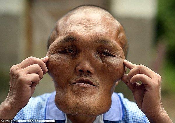 Doku büyümesi hastalığından muzdarip olan 53 yaşındaki Xia Yuanhai, hayatının seyrini değiştirecek ameliyatı bekliyor.